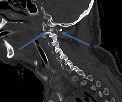 Always remember that numerous fractures can come from seemingly minor accidents. In this case, a 70-year-old fell downstairs, causing a fracture of the C1 ring. Image courtesy of Dr. Elizabeth Dick, first published in ECR Today newspaper.