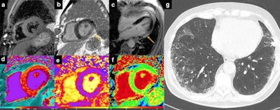 Myocarditis. 51-year-old man hospitalized for COVID‐19 pneumonia and sudden onset of tachyarrhythmias. short tau inversion recovery images revealed no edema (a), although late gadolinium enhancement (LGE) was evident on inferolateral segments of basal-mid planes with a subepicardial pattern of distribution (b, c: orange arrows) and native T1 was increased on LGE + segments (d). T2 mapping sequences revealed the presence of edema on inferolateral segments of mid-ventricular planes (e). Extracellular volume confirmed those findings with implemented values on inferolateral wall (f). Chest CT showed ground glass opacity predominantly distributed on inferior lobes with a peripheral distribution (g). All images courtesy of Dr. Federica Catapano and Prof. Marco Francone and Insights into Imaging.