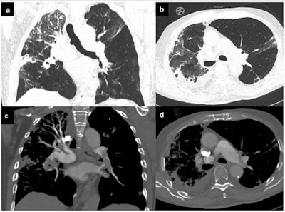 Pulmonary embolism. COVID-19 patient with dyspnea, increased D-dimer levels, and oxygen saturation < 93. Chest CT evidenced ground-glass opacity with interstitial thickening of the interlobular and intralobular septa, together with pleural effusion (a, b). After contrast media injection, pulmonary embolism was found in the left upper lobar branch, the left inferior lobar branch, and the segmental arteries for the left inferior pulmonary lobe and pulmonary embolism of the interlobar arteries for the inferior right lobe, probably extended to the subsegmentary arteries (c, d).