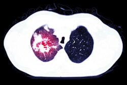2021 03 02 20 20 0903 Covid 19 Pulmonary Embolism 400