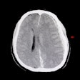 2021 03 04 00 47 4155 Ct Brain Hemorrhage Edema 400