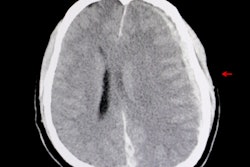 2021 03 04 00 47 4155 Ct Brain Hemorrhage Edema 400