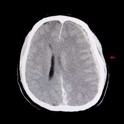 2021 03 04 00 47 4155 Ct Brain Hemorrhage Edema 400