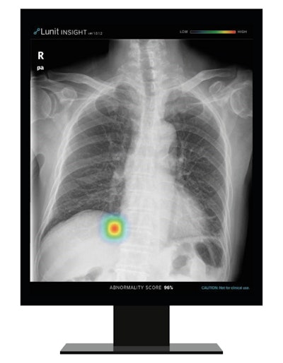 Lunit's Insight CXR algorithm. Image courtesy of Lunit.