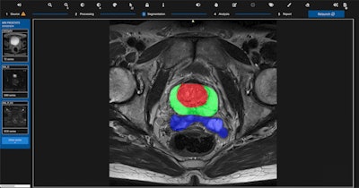 Quibim's qp-Prostate software. Image courtesy of Quibim.