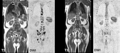 Images show a prostate cancer patient's evolution from multifocal skeletal metastases to normal marrow appearance. Coronal T1- and diffusion-weighted imaging (DWI)-MRI (two left images) show multiple foci of low signal intensity corresponding to metastases (arrows). After systemic therapy, follow-up images (right two images) show complete disappearance of the lesions and return to normal homogeneous signal intensity of the bone marrow. Images courtesy of Dr. Frédéric Lecouvet, PhD.