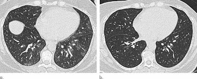Axial unenhanced inspiratory CT images of the lungs of a 51-year-old woman before (a) and six months after (b) bariatric surgery that led to a 31-kg (68 pounds, or nearly five stone) weight loss (body mass index fell to 36.1). The mosaic attenuation seen before surgery was resolved after surgery. (Images courtesy of Dr. Susan Copley and Radiology).