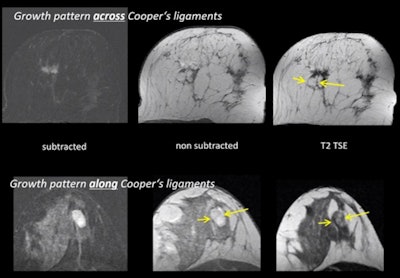 Radiologists should check for tumor growth in relation to Cooper's ligaments, the bands of tough, fibrous, flexible connective tissue that shape and support breasts.