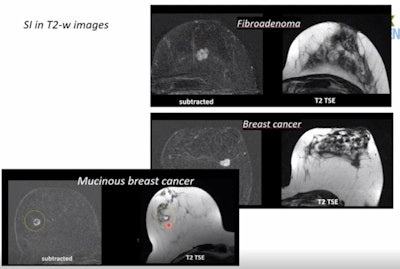 Benign tumors have higher signal on T2-weighted images, with the exception of mucinous breast cancer.
