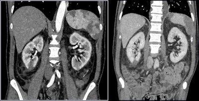 Contrast-enhanced CT shows renal vascular injury in a patient with COVID-19. Findings include severe hypercoagulability state, renal infarction, and wedge-shaped hypoenhancing and nonenhancing areas. All images courtesy of Prof. Riccardo Manfredi.