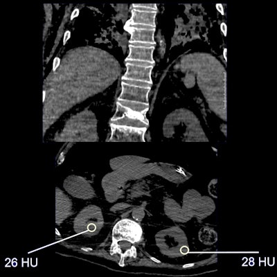 Nonenhanced CT shows renal parenchymal attenuation and edema and inflammation in COVID-19 patient. From: Li Z et al, Caution on Kidney Dysfunctions of COVID-19 Patients, medRxiv, 27 March 2020. This study found statistically significant lower CT value in COVID-19 patients; 27.3 HU (COVID-19 group) versus 33.2 HU (control group).