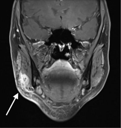Coronal MR image (above) shows a lesion in the right masseter muscle approximately at the level of the jaw angle (white arrow), within and overlying the lateral masseter margin. Axial MR image (below) shows inflammation involvement of the surrounding adipose tissue and the right ventrocaudal parotid tip (white arrow).
