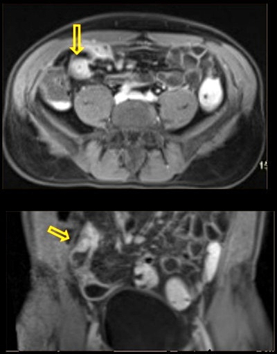 58-year-old man with a history of diffuse abdominal pain. Incidental finding on prostate screening: ileal wall thickening and increased mural contrast enhancement, suspicious of intestinal inflammatory disease. Crohn's disease was confirmed posteriorly. All figures courtesy of Dr. Eduardo Alvarez-Hornia Pérez.