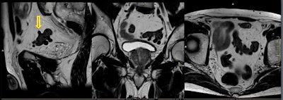 74-year-old man with diverticular disease. Incidental finding on prostate screening: multiple diverticula of the sigmoid colon without evidence of diverticulitis.