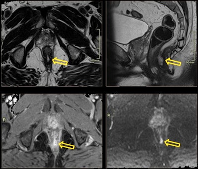 68-year-old man with rectal fistula presented for prostate screening and complained of rectal discomfort. Posterior fistula and abscess were discovered.