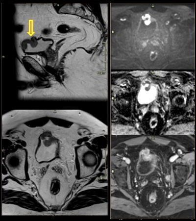 67-year-old man with vesicle cancer. High prostate-specific antigen (PSA) level and hematuria. Incidental finding: polypoid lesion on anterior wall of bladder with restricted diffusion and contrast enhancement.