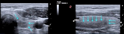 A 46-year-old man two to three months after COVID-19 infection. Thyroid ultrasound scan in transverse (left) and longitudinal (right) planes shows presence of focal hypoechoic area (arrows) suggestive of thyroiditis in left thyroid lobe, inferior and posterior position. All figures courtesy of Dr. Ilaria Muller, PhD, presented at ENDO 2021.