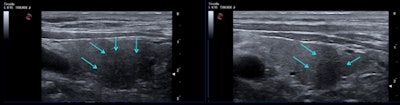 Thyroid ultrasound scan (longitudinal plane) of a 73-year-old man with COVID-19. Left: three months after infection. Presence of a focal hypoechoic area (arrows) suggestive of thyroiditis in his right thyroid lobe, inferior and posterior position. Right: six months postinfection, the hypoechoic area is still there, but much reduced in size.