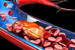 2021 03 24 20 21 9874 Blood Vessel Embolism Dvt 400