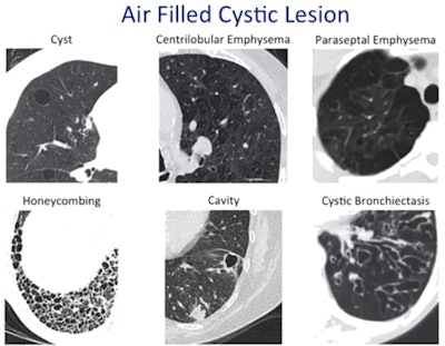 Various entities cause air-filled cystic lesions which need differentiation on CT. Courtesy of Prof. Peter Beddy.