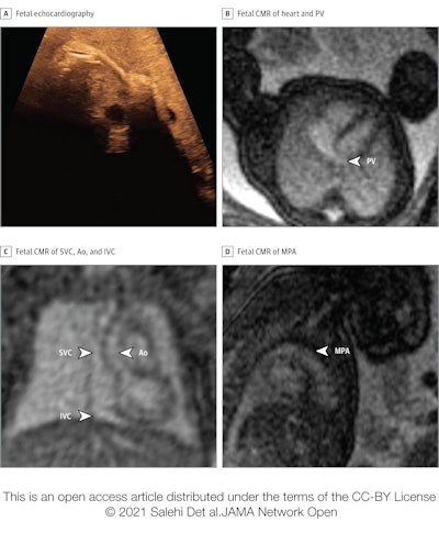 Basic assessment in a fetus with risk factors for cardiac malformation and a very poor acoustic window. The fetal heart and vessels were not visible at all during fetal echocardiography, due to mother having obesity (A). Fetal cardiovascular MRI showed normal-sized ventricles with normal systolic function and at least one normal pulmonary vein (PV) without obvious direct or indirect signs of aberrant pulmonary veins (B), superior venae cavae (SVC) and inferior venae cavae (IVC) and normal ascending aorta (Ao) (C), and normal main pulmonary artery (MPA) (D). This information ruled out major congenital heart disease, and delivery was planned at the hospital closest to the patient's home. A nonurgent postnatal echocardiography examination was performed before discharge, which showed a normal cardiovascular anatomy.