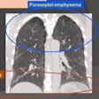 2021 03 29 16 01 4512 2021 03 29 Lung Ct Capture6 400 Version2
