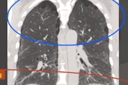 2021 03 29 16 01 4512 2021 03 29 Lung Ct Capture6 400 Version2
