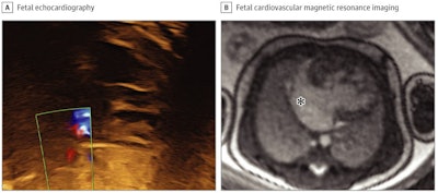 Evaluation of atrial restriction in a fetus with hypoplastic left heart syndrome. Fetal echocardiography could not visualize the atrial cavity or Doppler flow across the atrial septum due to poor acoustic windows (A). Fetal cardiovascular MR showed a large interatrial communication, indicated by the asterisk, and no nutmeg pattern (B). Therefore, the risk of restrictive atrial septum was considered low (albeit a membrane could not be ruled out), and the fetus was planned for a vaginal delivery without cardiac catheterization laboratory on standby. Contrast and brightness in the cardiovascular MR image have been optimized for printing. All figures courtesy of JAMA Network Open.