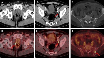 Examples of individual minor and major therapeutic change in patients with biochemical recurrence after radical prostatectomy undergoing F-18 rhPSMA 7.3 PET/CT examination