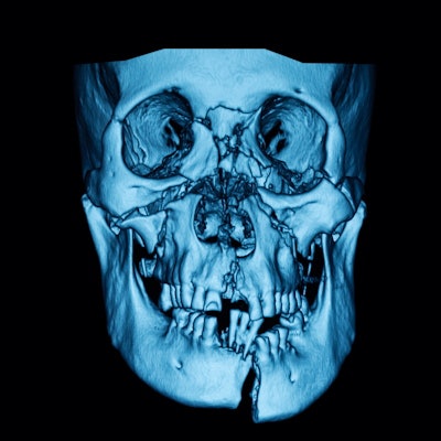 2021 04 01 16 15 6329 Ct Facial Fractures 400