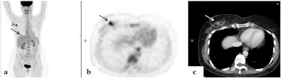 FDG-avid multifocal breast lesions. An 84-year-old woman with a multifocal cancer in the left breast and multiple bone FDG-avid metastatic lesions. FDG-PET/CT: maximum intensity projection (MIP) (a), a representative PET (b), and CT axial slices (c). Images courtesy of Surgical Oncology.
