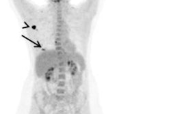 2021 04 08 23 04 5289 2021 04 06 23 20 6542 2021 04 07 Fdg Uptake Breast 20210407000006