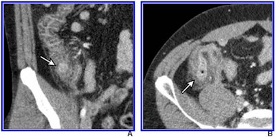 Intravenous contrast-enhanced 2-mSv 4-mm-thick transverse and coronal (B) CT images show inflamed diverticula (arrows), segmental colonic wall thickening, and adjacent pericolic fat stranding. Images courtesy of the American Roentgen Ray Society and the American Journal of Roentgenology.