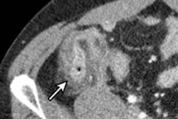 2021 04 09 18 18 9331 2021 04 09 Ct Diverticulitis Image 20210409182755