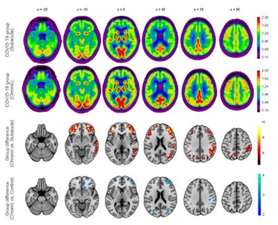 Results of the F18-FDG PET group analysis. First and second row: Transaxial sections of group averaged, spatially normalized F-18 FDG PET scans in patients at the subacute and chronic stages. Third and fourth rows: Regions that show significant increases of normalized F-18 FDG uptake in patients at the chronic compared with the subacute stage. Fourth row: Regions that still show significant decreases of normalized F-18 FDG uptake in patients at the chronic stage compared with the age-matched control cohort (two-sample t test, p < 0.005). Statistical parametric mapping t-values are color coded and overlaid onto an MRI template. Images are presented in neurologic orientation: the left image side corresponds to patients' left body side; numbers denote axial (Z) position in mm. Image courtesy of the Journal of Nuclear Medicine.