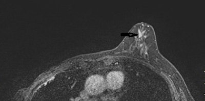 A 53-year-old woman with previous right mastectomy and uniporous left bloody discharge. Above: MRI axial plane after injection with fat saturation shows a left nonmass enhancement with linear distribution in the inner inferior quadrant (arrow). Below: Second-look ultrasound demonstrates three ducts of normal caliber in correlation (arrow). 10-G vacuum-assisted biopsy under ultrasound guidance revealed papilloma removed by surgical excision. Images courtesy of Dr. Martine Boisserie-Lacroix and European Radiology.