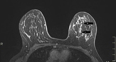 MRI axial plane after injection with fat saturation (above, arrows) and subtraction (below) shows a large nonmass micronodular enhancement with segmental distribution in the inner left quadrants. Mastectomy: 130-mm ductal carcinoma in situ with microinvasion. Images courtesy of Dr. Martine Boisserie-Lacroix and European Radiology.