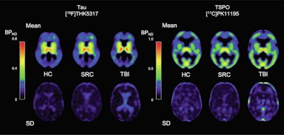 Image shows mean THK5317 and PK11195 nondisplaceable binding potential (BPND) for controls, rSRC and TBI patients, depicting tau and translocator protein (TSPO) expression, as well as corresponding standard deviation images. In symptomatic rSRC athletes, a voxel-wise t-test showed clusters of significantly increased THK5317 binding in the corpus callosum and subcortically including the medial temporal region and PK11195 binding in the medial temporal lobes. In TBI, elevated tau and TSPO binding was observed in the thalamus, temporal lobe white matter and midbrain. Significant group differences in total tau load were found between healthy controls and rSRC in subcortical grey matter (SRC 7.5 ± 0.9, controls 6.7 ± 0.5, p = 0.038), although not between TBI patients and controls. No significant differences in the number of voxels with THK5317 BPND > 0.5 or skewness in BPND distribution were found. Image courtesy of NeuroImage: Clinical.