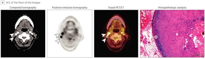 Images of a 71-year-old woman with SCC of the floor of the tongue. Although the CT image is rather unremarkable, PET depicted intense focal tracer uptake in two cervical lymph nodes (arrowheads), which is highly consistent with metastatic disease. PET findings could be confirmed by histopathologic analysis with the presence of a keratinizing, moderately to poorly differentiated SCC. Only a small rim of retained lymph node tissue could be identified (star) and most of the lymph node was occupied by carcinoma. All images courtesy of JAMA Network Open.