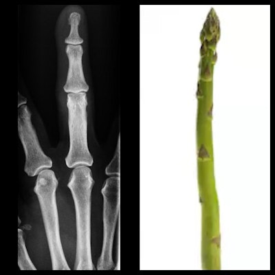 Asparagus finger. X-ray of finger, phalanx looks like an asparagus tip.