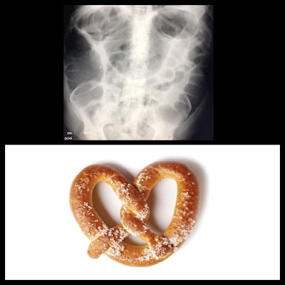 Colonic pretzel. Abdominal x-ray of colon looks like a pretzel.