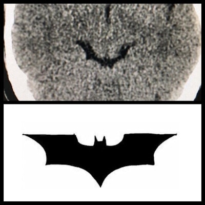 Batman quadrigeminal cistern. A brain CT (axial) of normal quadrigeminal cistern looks like the Batman logo.