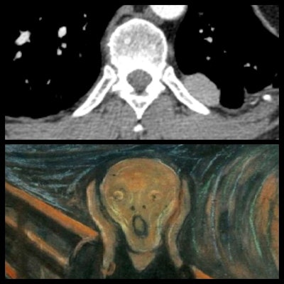 The vertebral scream. Chest CT (axial) of normal vertebra, spinal canal, and posterior ribs looks like the Scream by Edvard Munch.