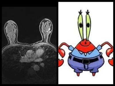 Breast crab. Breast MRI (axial) of breasts and thoracic cavity looks like Mr. Krabs, a character in the U.S. animated TV series SpongeBob SquarePants.