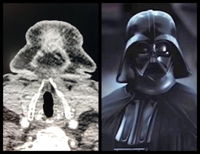 Neck Vader. Neck CT (axial) of anterior cervical region looks like Darth Vader (Star Wars). All figures courtesy of Dr. YasmĂn El Khatib Ghzal, ECR 2021, and @radiologypareidolia.