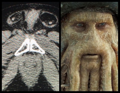 Davy Jones pelvis. Pelvic CT (axial) of pubis, inguinal canals looks like Davy Jones (Pirates of the Caribbean).