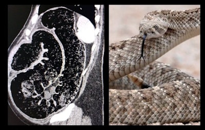 Colonic snake. Abdominal CT (sagittal) of large bowel obstruction looks like a snake.
