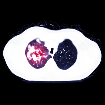 2021 03 02 20 20 0903 Covid 19 Pulmonary Embolism 400