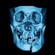 2021 04 01 16 15 6329 Ct Facial Fractures 400