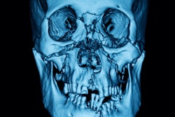 2021 04 01 16 15 6329 Ct Facial Fractures 400